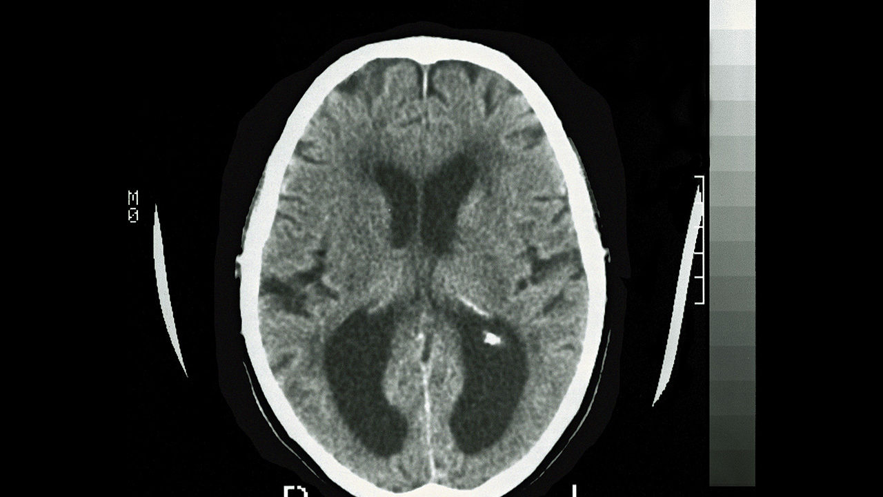 University of New Mexico researchers develop potential Alzheimer's vaccine