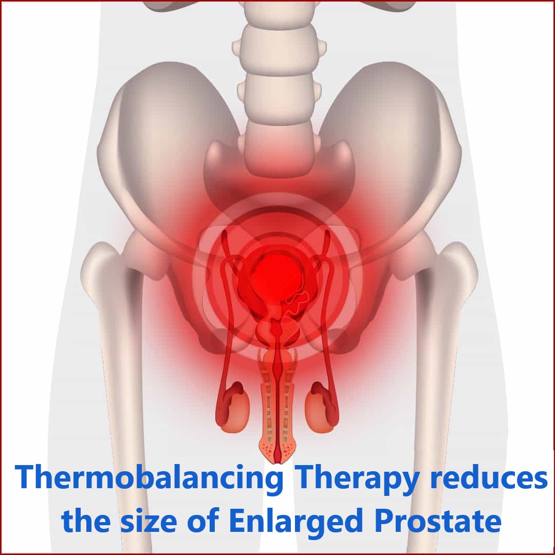 Enlarged Prostate Thermobalancing Treatment Can now Help to Avoid Sexual Problems