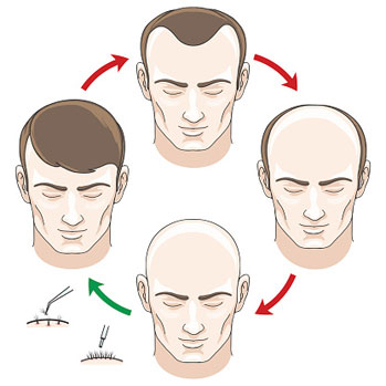 Breakthrough Hair Cloning Technology Developed by UK Scientists