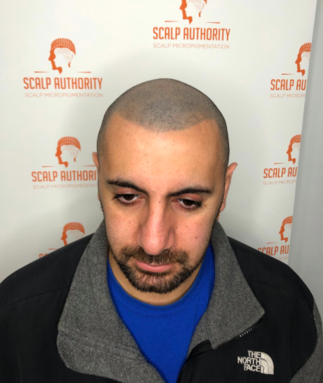 Scalp Authority is the Authority at Scalp Micropigmentation and Helping People Succeed Over their Hair Loss Struggles