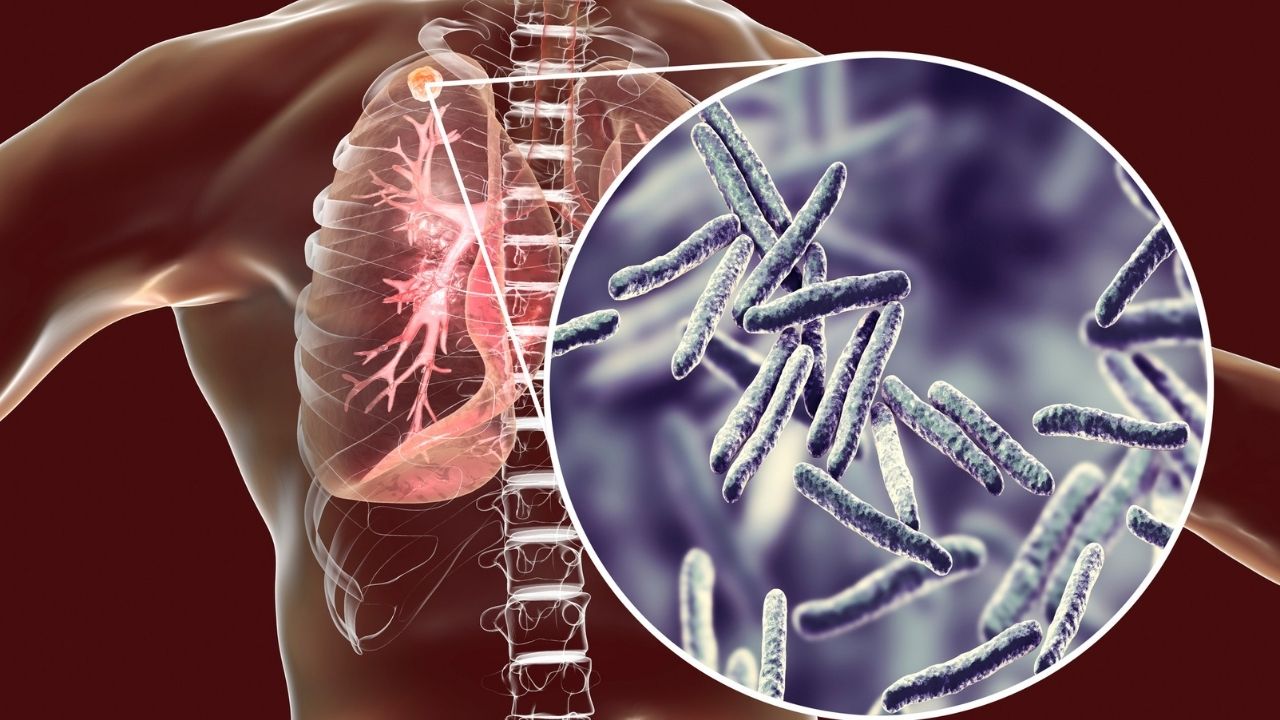 Three Strategies for Improving TB Screening in Remote Areas