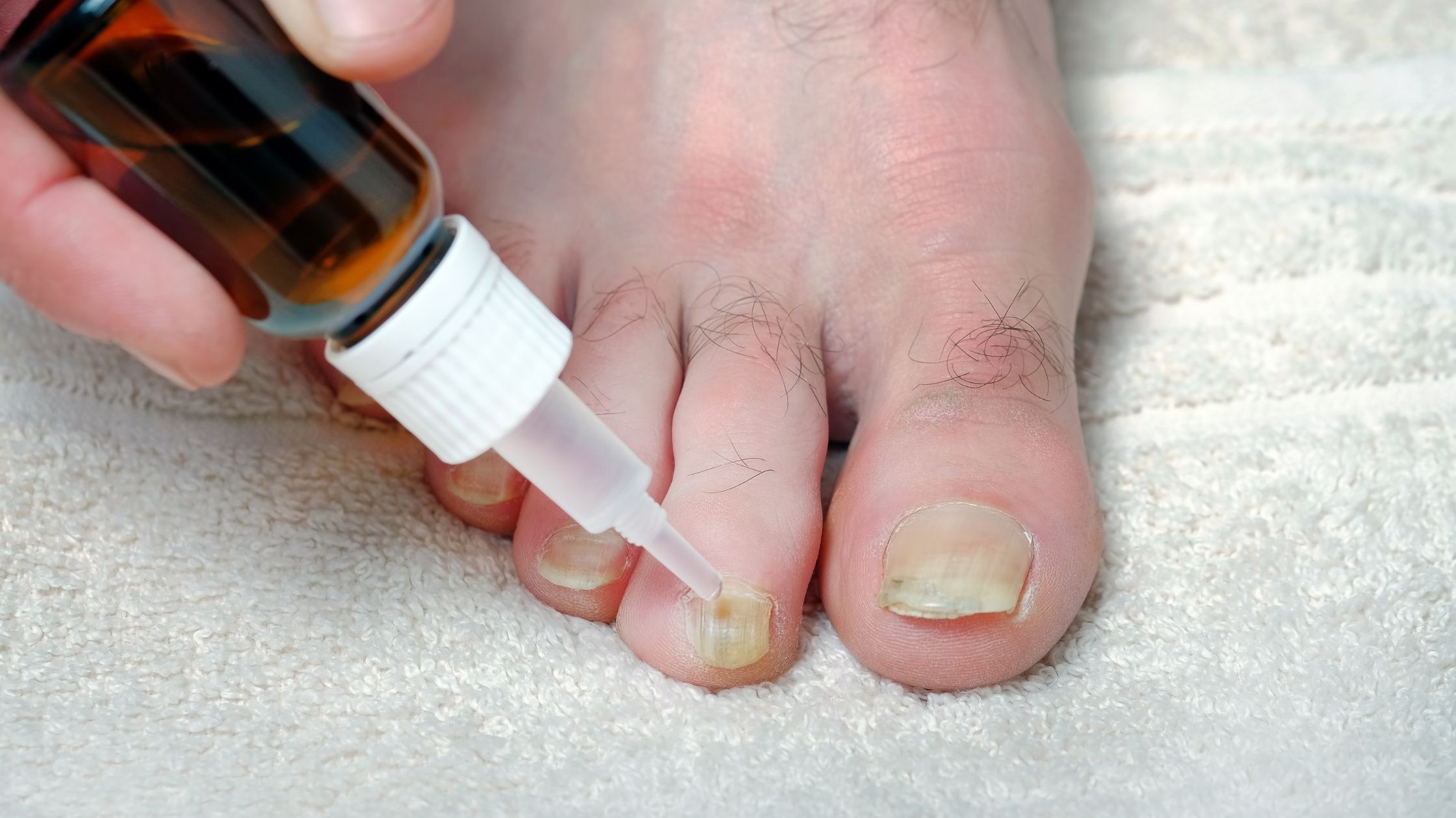 Nail Fungus Infection is Easy to Cure if One Follows the Necessary Medical Practices on Time