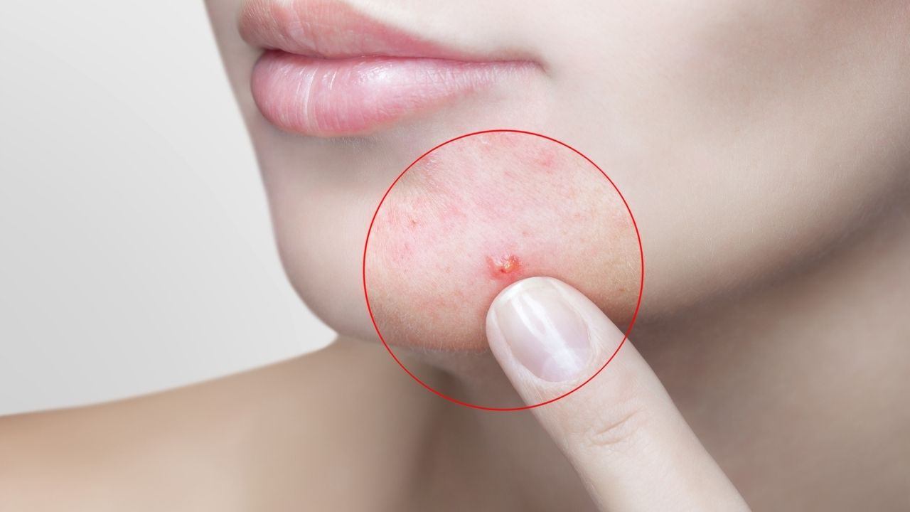5 Skin Care Tips to Control Acne