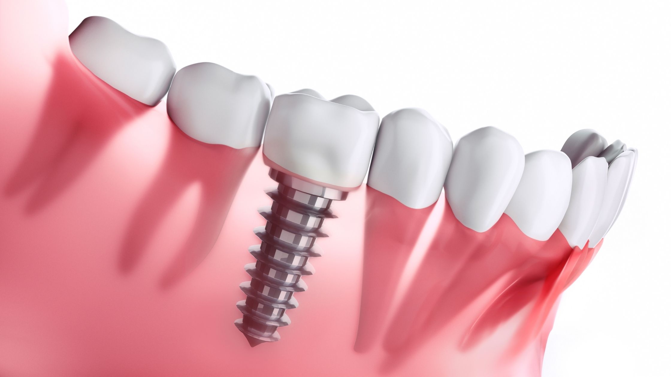 Dental Experts Share Some Things Every Person Should Consider Before Going for a Dental Implant Procedure