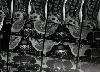 Common Injuries Resulting from Car Accidents