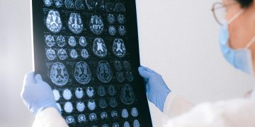 The Long Road to Recovery After a Brain Injury